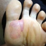 [blister photo]